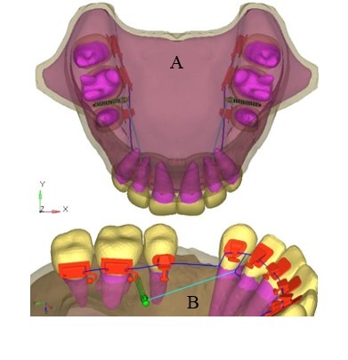 Evaluation of stress generation on the cortical bone and the palatal micro-implant complex during the implant-supported en masse retraction in lingual orthodontic technique using the FEM: Original research.